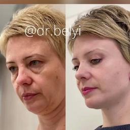 Facelift. Sicheres Heben von Kleinstgewichten.